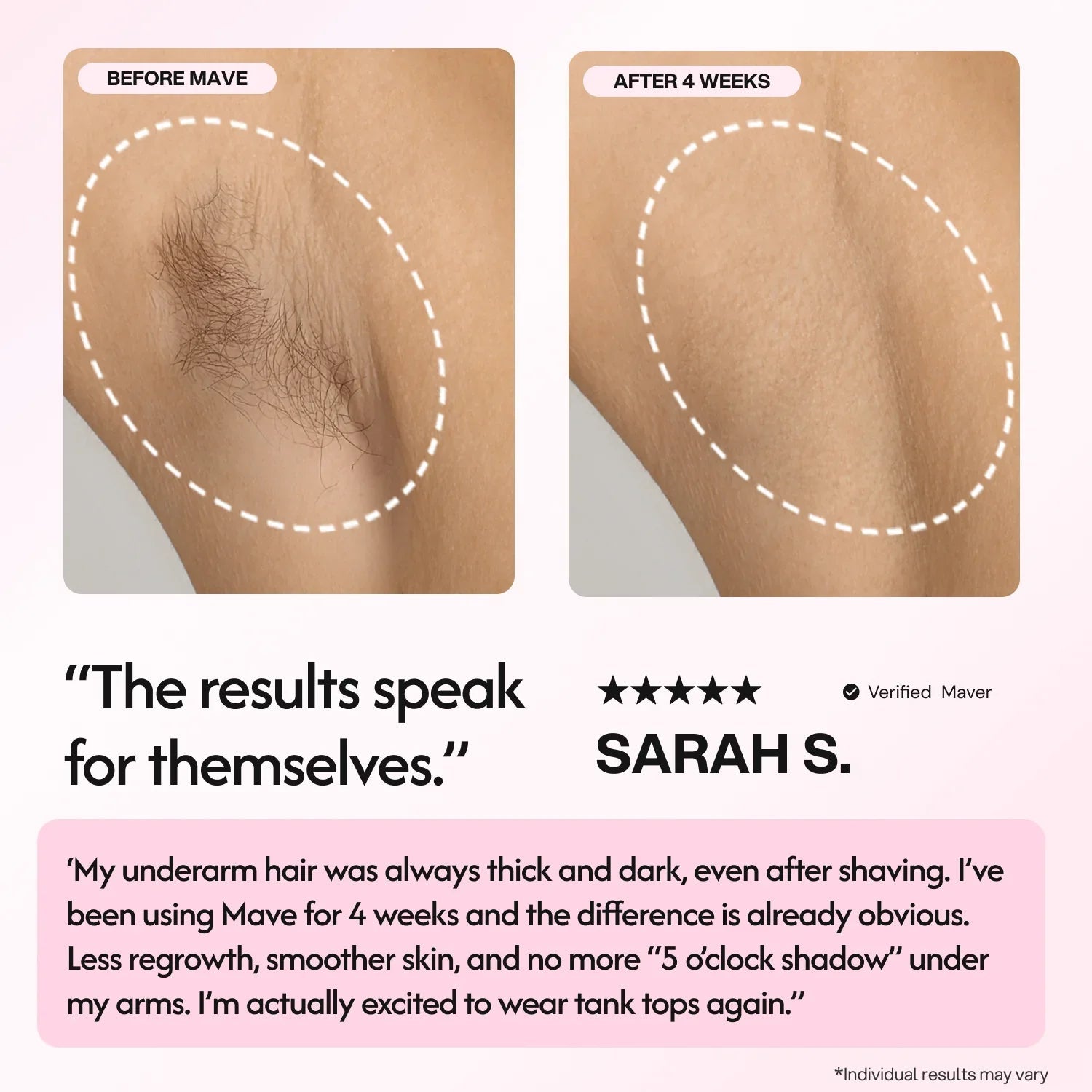 Mave IPL Hair Removal Handset
