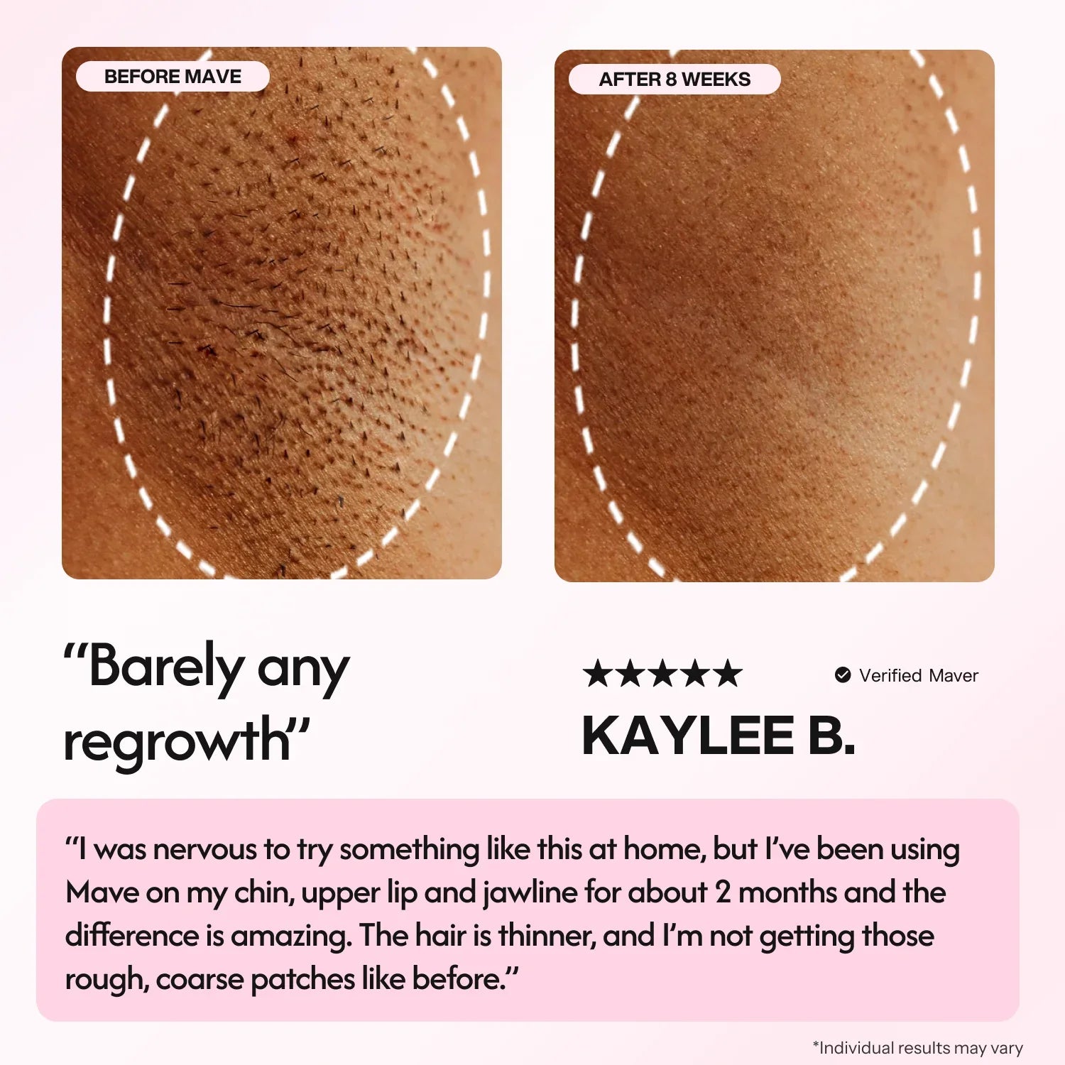 Mave IPL Hair Removal Handset