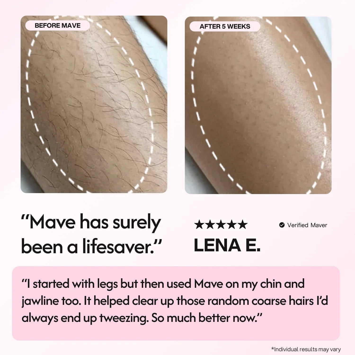 Mave IPL Hair Removal Handset